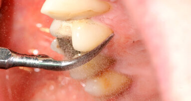 Miglior controllo del diabete di Tipo 2 col trattamento parodontale non chirurgico