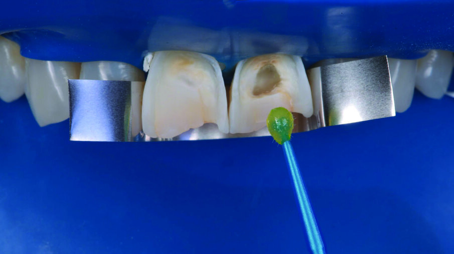 3M™ Scotchbond™ Universal Adhesive was applied to the rinsed and dried tooth structure. The adhesive was rubbed for 20 seconds, treated with a gentle stream of air for solvent evaporation, and light cured for 10 seconds.