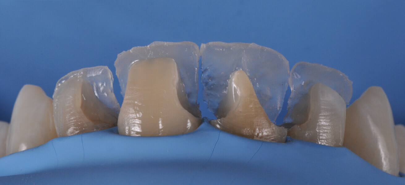 Fig. 13: Palatal walls built up with CLEARFIL MAJESTY ES-2 Premium in the shade A1E with the aid of the palatal silicone index.