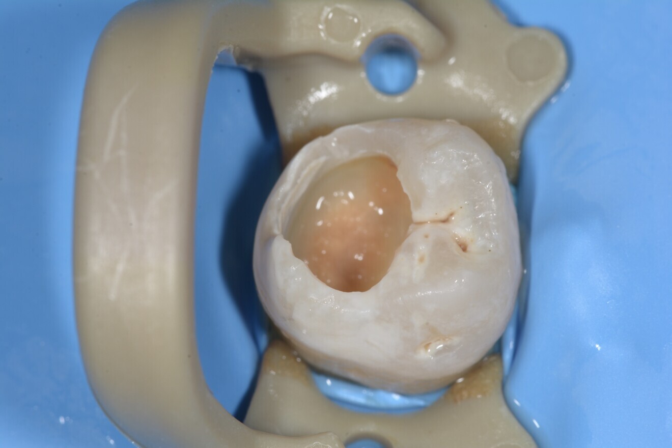 Fig. 11 : Préparation de la cavité.
