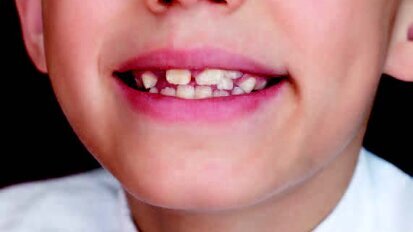 Οι συγκλεισιακές ανωμαλίες επηρεάζουν τη στάση του σώματος και την ισορροπία