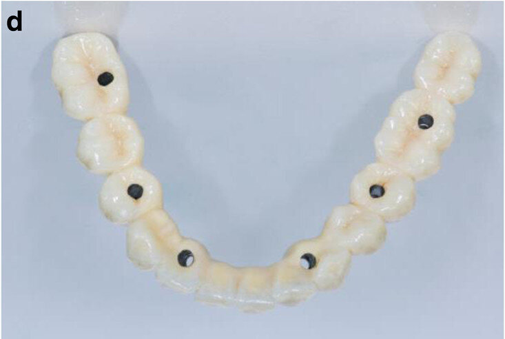 Fig. 13d: CAD/CAM-fabricated one-piece cobalt–chromium framework before (a & b) and after veneering with composite (SR Nexco Paste, Ivoclar Vivadent), that is the final FDP (c & d).
