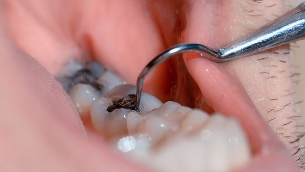 Europees Parlement verbiedt amalgaamvullingen