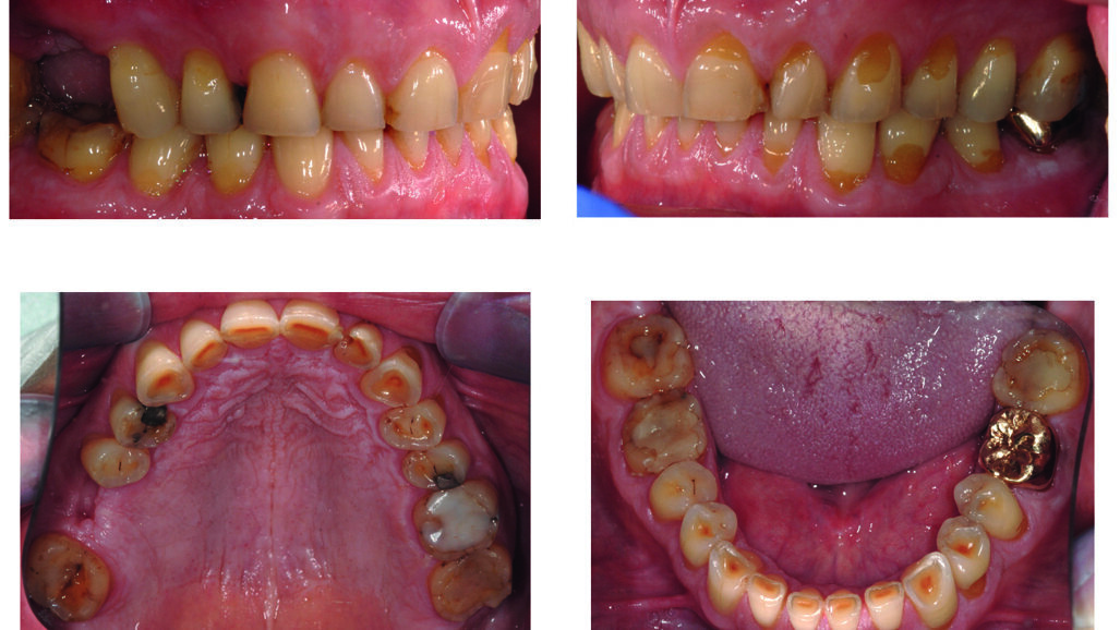 Case report: protesi adesiva di paziente con grave usura dentale. Follow-up a 4 anni