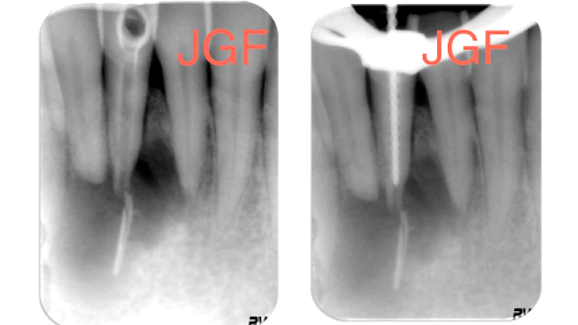 La reparación de la lesión apical compleja