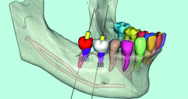 Flux de travail numérique et intelligence artificielle en implantologie