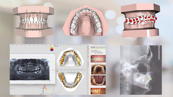 CBCT-based crown–root set-up supports anatomy-guided orthodontic planning