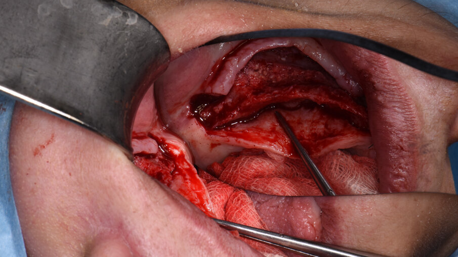 Obr. 7a, b: Výsledek první horizontální augmentace na pravé straně (a) a na levé straně (b).