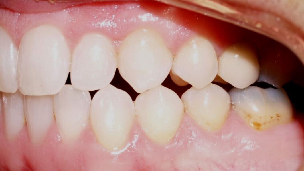 Fig. 9: After three months of extrusion. 