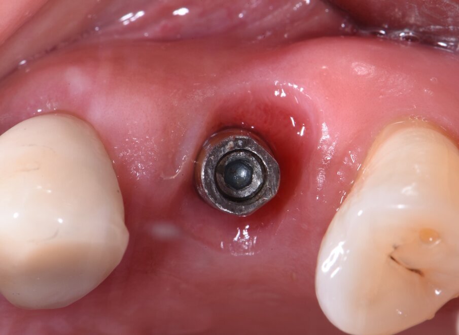 Figg. 4a, 4b - Inserimento del moncone e presa dell’impronta digitale.