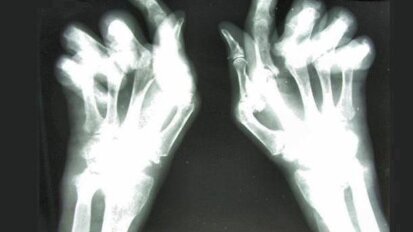 RZS wpływa na stan zdrowia dziąseł