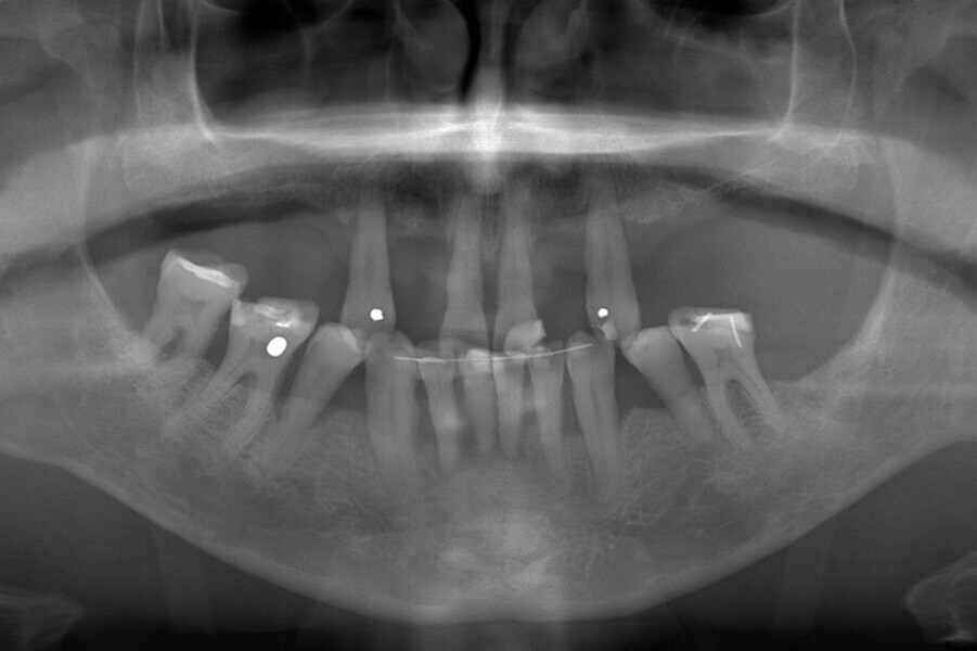 Fig. 16. Rx Pre-operatoria, Prótesis híbrida inmediata con 6 años de evolución y Rx Control a los 6 años.