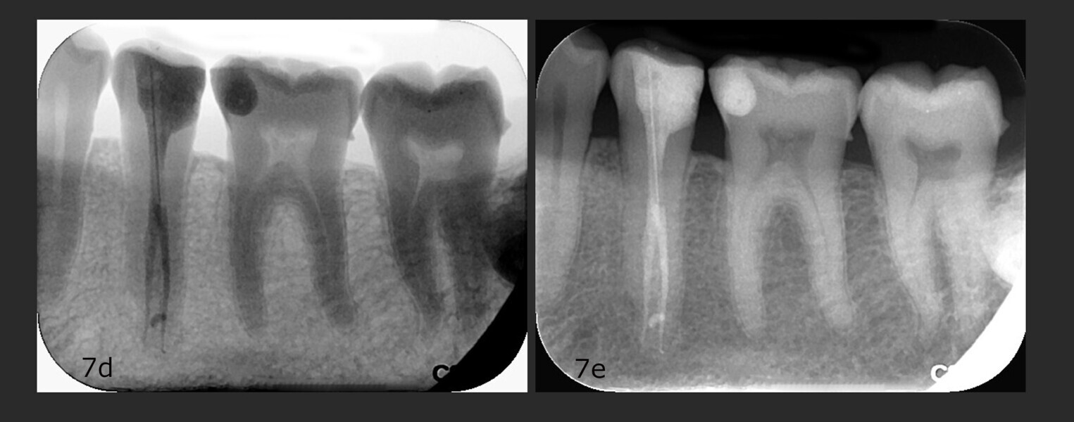 Figs. 7d & e: Periapical radiograph after five years.
