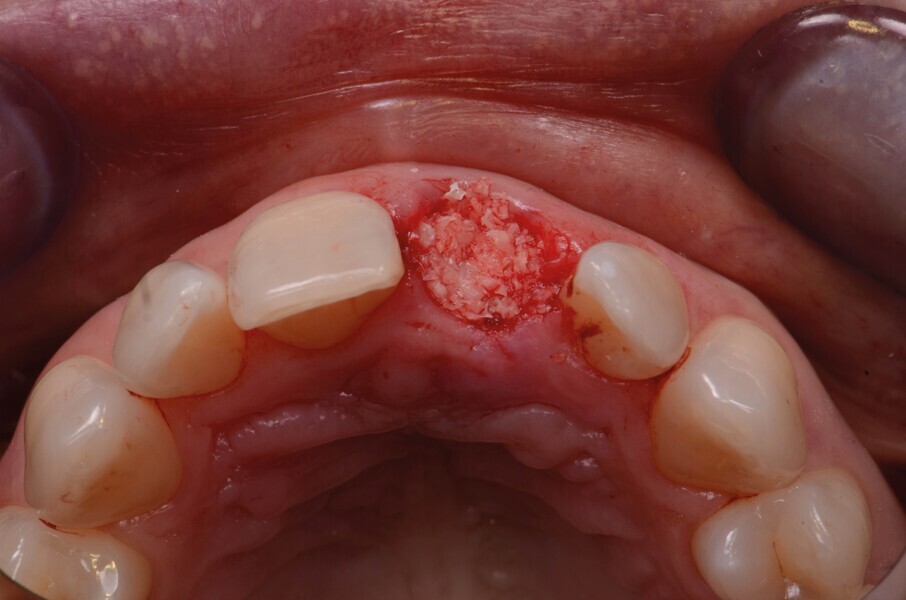 Fig. 5c : L’alvéole est comblée par un greffon allogénique (poudre d’os PHOENIX, TBF).