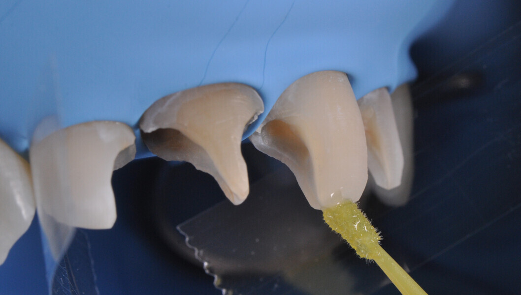 Fig. 12: Application of a universal adhesive (CLEARFIL Universal Bond Quick, Kuraray Noritake Dental).