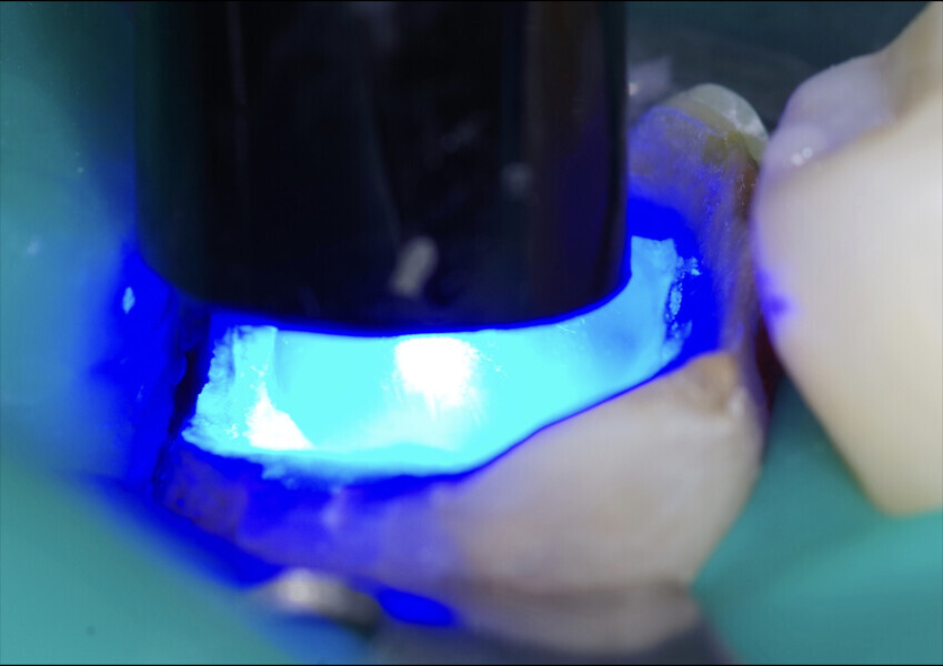 Fig. 9: Polymerising of the core build-up composite with the Celalux 3.