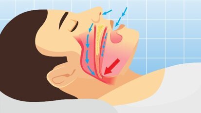 Rivisitazione delle linee guida mondiali per la diagnosi delle apnee notturne