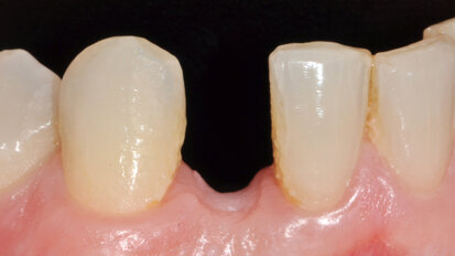 Jednoduchá rekonstrukce u problematického případu s omezeným prostorem