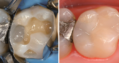 Webinar hinterfragt Wirtschaftlichkeit von Kompositversorgungen