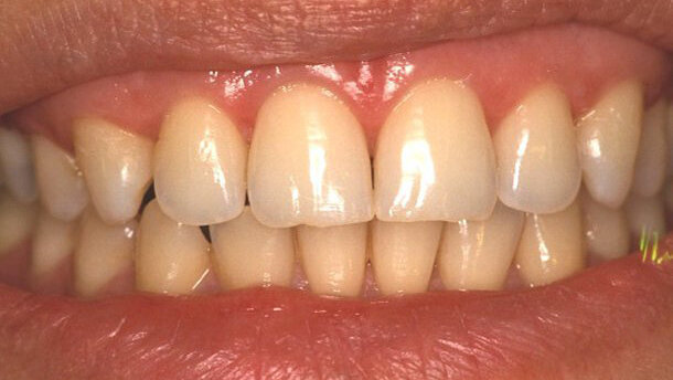 La difusión de la luz en las restauraciones directas