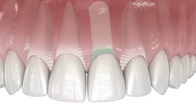 Symbionic Teeth : le remplacement dentaire avec barrière protectrice muqueuse