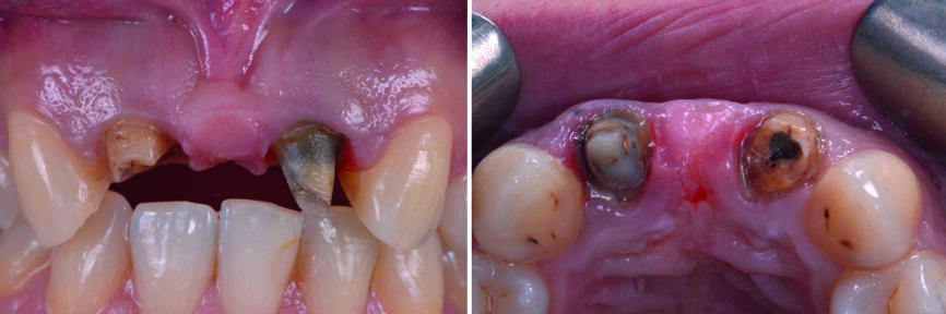 Fig. 9 : Vue intra-orale après élimination de la restauration céramo-métallique indésirable. 