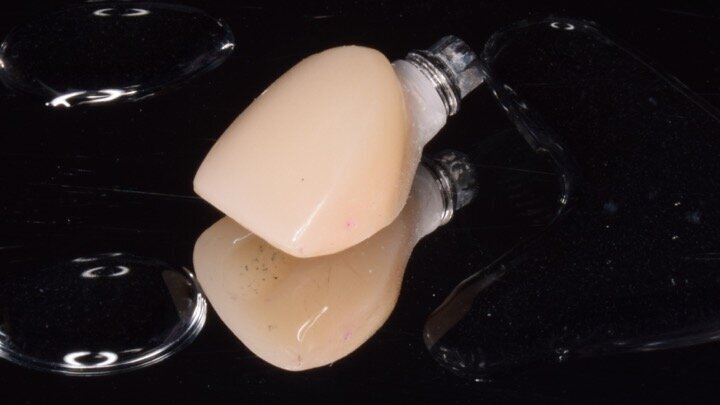 Figuras 12 y 13. En el laboratorio realizan la prótesis provisional en acrílico sobre un semicalcinable con conexión mecanizada para verla en la radiovisiografía (RVG). Dicha prótesis provisional tendrá un perfil de emergencia cóncavo para dejar ese espacio vacío que ocupará el coágulo sanguíneo, transformándose en tejido conectivo posteriormente.