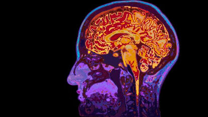 Scoperto un legame tra batteri orali, microemorragie cerebrali e ictus