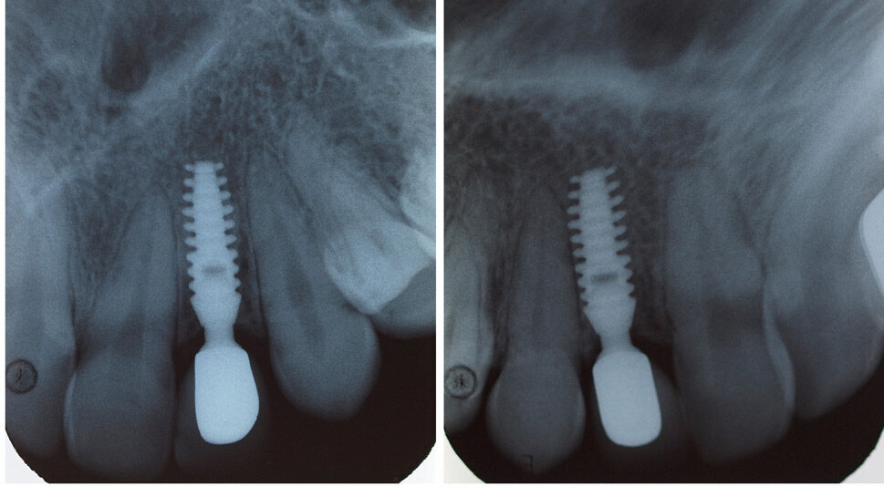 Отпаднаха лицензите за денталните секторни рентгени