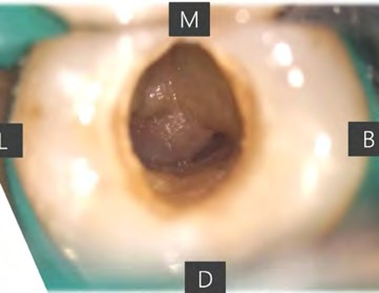 Fig.  1d: Following successful bypass, the separated instrument was retrieved using an ET25 ultrasonic tip with counterclockwise activation under microscopic visualization. 