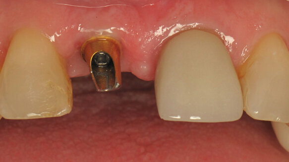 The Hiossen ETIII Implant System: A coordinated approach to esthetic restorations
