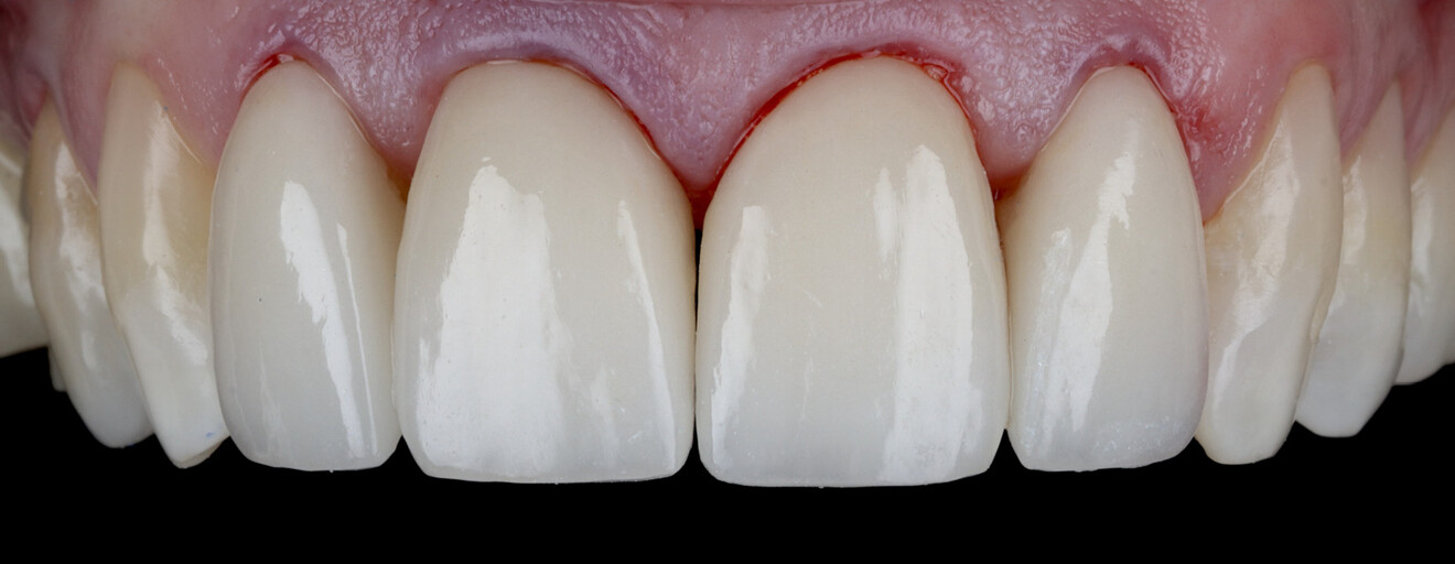 Fig. 22: Immediate postoperative result after cementation, showing mild gingival erythema, consistent with a transient tissue response after adhesive procedures.
