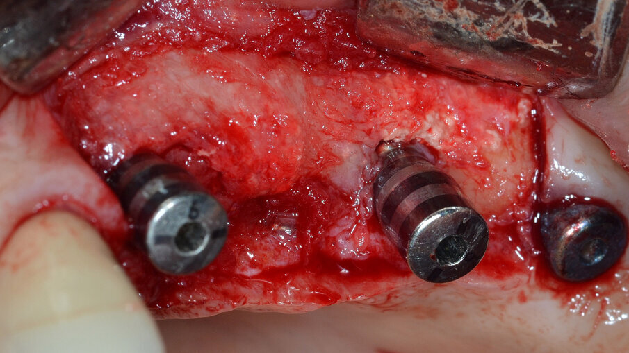 Fig. 14 - Lembo riposizionato apicalmente e suturato con punti a materassaio orizzontale incrociati e punti staccati.