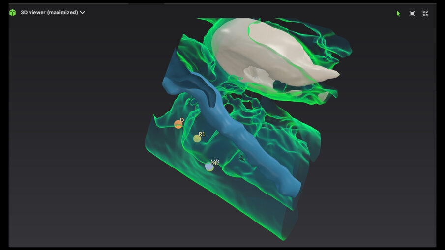 Sl. 15: 3D rekonstrukcija koja pokazuje da je nerv zaobišao bukalno područje i dodirnuo samo srednji deo mezijalnog kanala