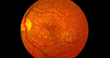 Ricercatori scoprono una possibile connessione tra cecità e perdita dei denti nei maschi