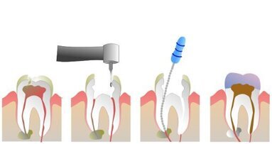 Una nuova procedura dentale potrebbe sostituire la devitalizzazione
