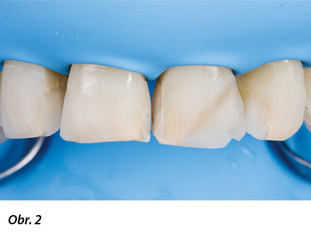 Zajištění suchého pracovního pole po očištění, dezinfekci a vyleštění povrchu zubů.