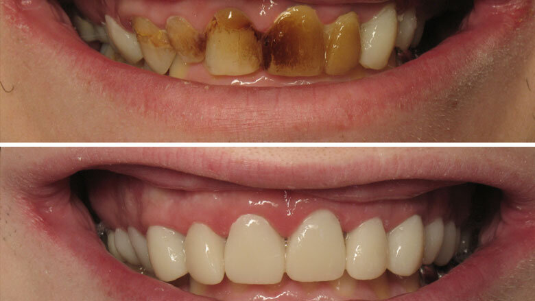 Figura 9. Comparación del caso inicial y final.
