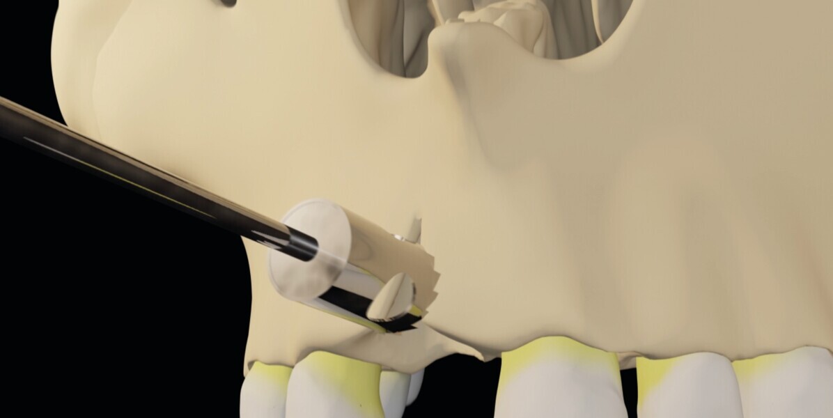 Fig. 3 : Un trépan pour calibrer le défaut osseux en forme circulaire.