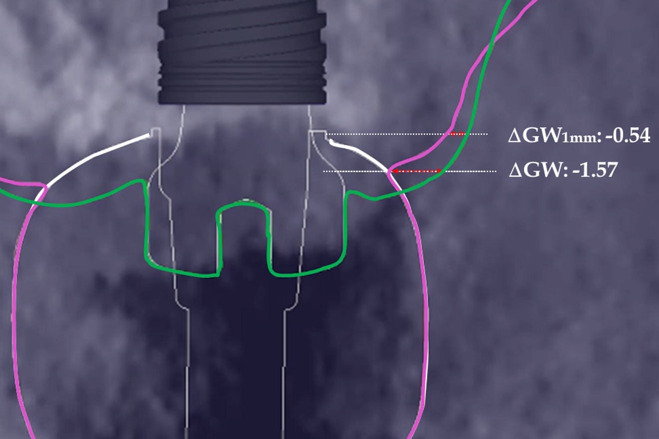 Fig. 7e: Measurement of the negative change in GW on the buccal side between the end of the healing period and prosthesis delivery at the level of the sulcus (∆GW) and the most apical level of the crown (∆GW1mm). GW lost 1.57 mm at the level of the sulcus. 