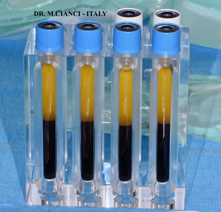 Fig. 5 - Plasma dopo la centrifugazione.