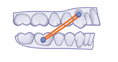 El protocolo clínico CA® CLEAR-ALIGNER y por qué es así