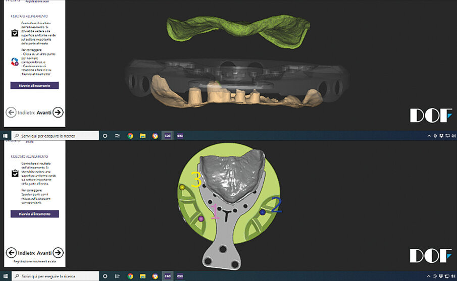 Figs. 7 & 8: Import into the exocad software after scanning of the individual impressions and dentures using the laboratory scanner.