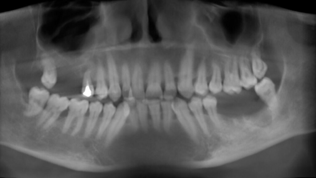 Valutazione con CBCT dell’aumento osseo verticale nella tecnica di rialzo del seno mascellare con approccio laterale: caso clinico