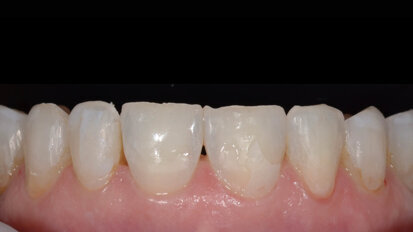 Fig. 2: Orthodontic treatment was performed to align the full arch.