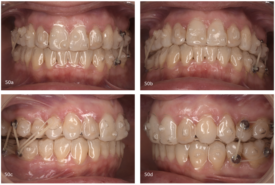 Figs. 51a–d: Third phase of aligner treatment and inter-maxillary elastics.