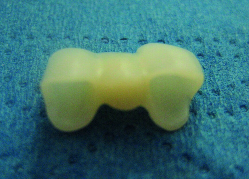 Fig. 10: Temporary FDP milled (dentallgroup.eu).
