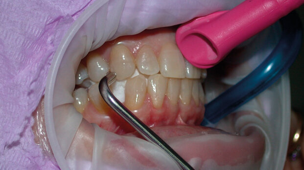 Procedura per il controllo dell’AP/EP (Air Polishing Ergonomics Procedure): tecnica, sicurezza e comfort del paziente
