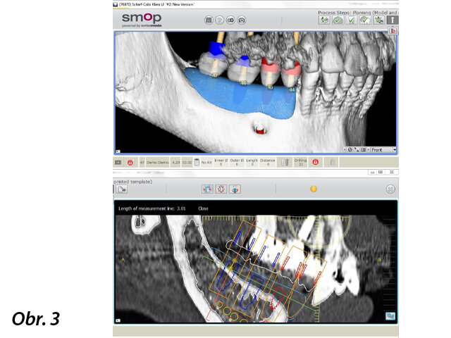 Předoperační digitální plánování chirurgického zákroku.