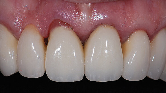 Restoring in the other color: pink